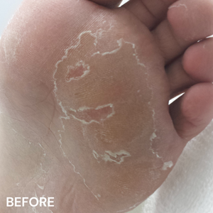 #7 Peeling Skin Formula