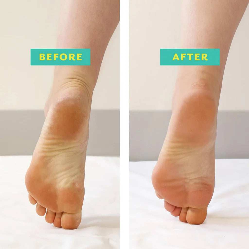 POSHPEEL™ Pedi Cure - Single
