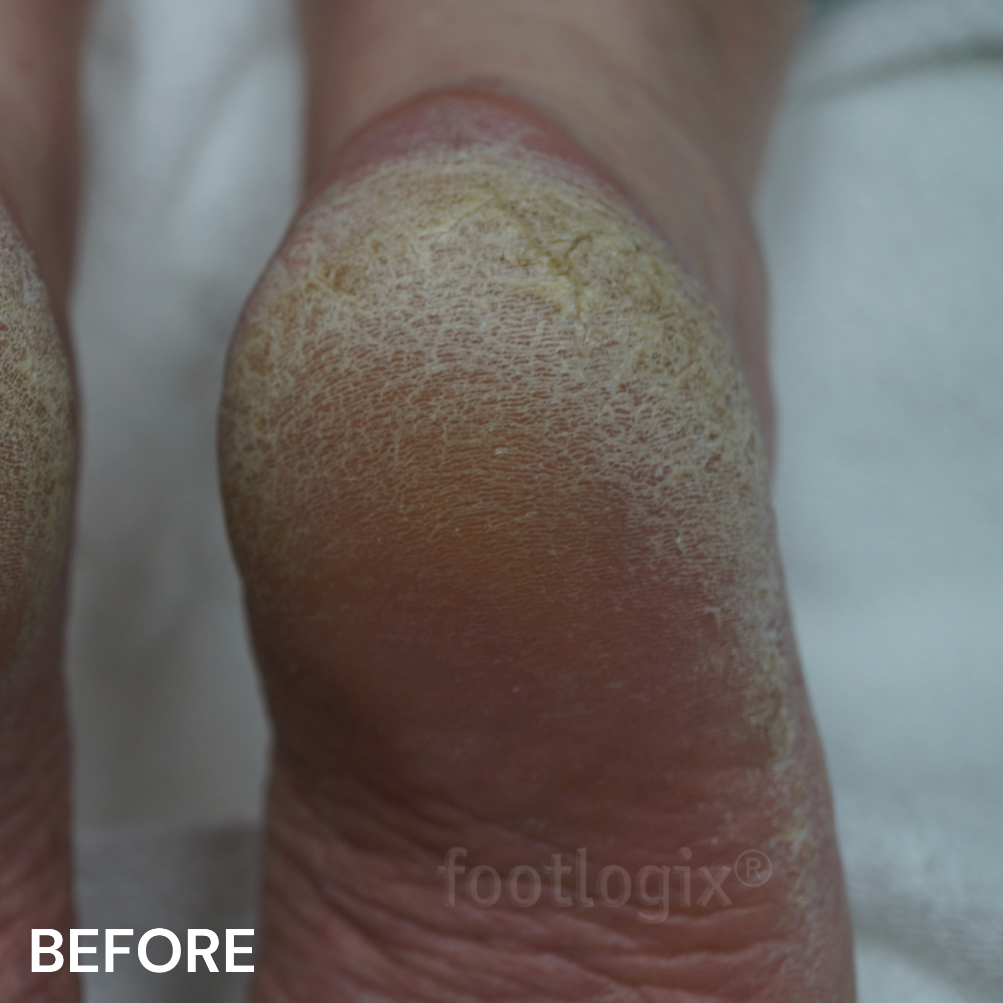 #7+ Rough Skin Formula
