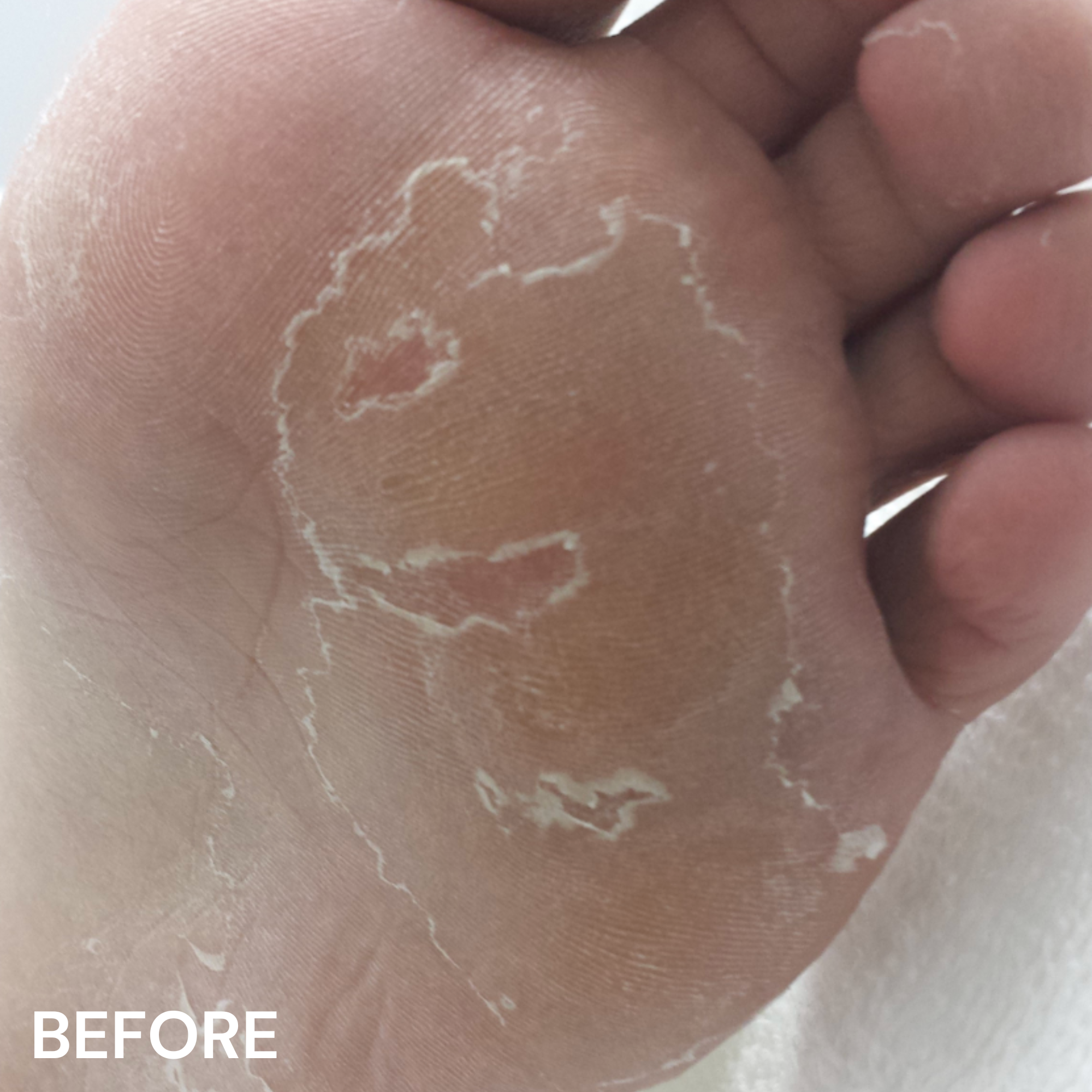 #7 Peeling Skin Formula