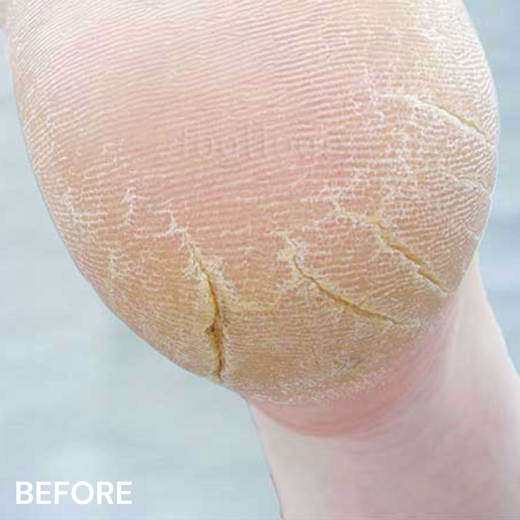 #3+ Cracked Heel Formula
