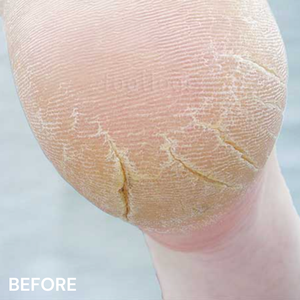 #3+ Cracked Heel Formula