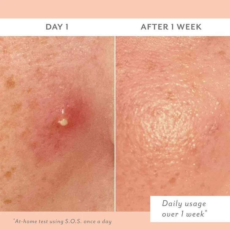 S.O.S. Totally Invisible Clarifying Liquid Patch