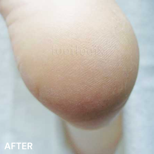 #3+ Cracked Heel Formula