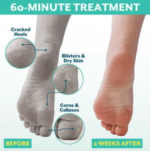 POSHPEEL™ Pedi Cure - Single